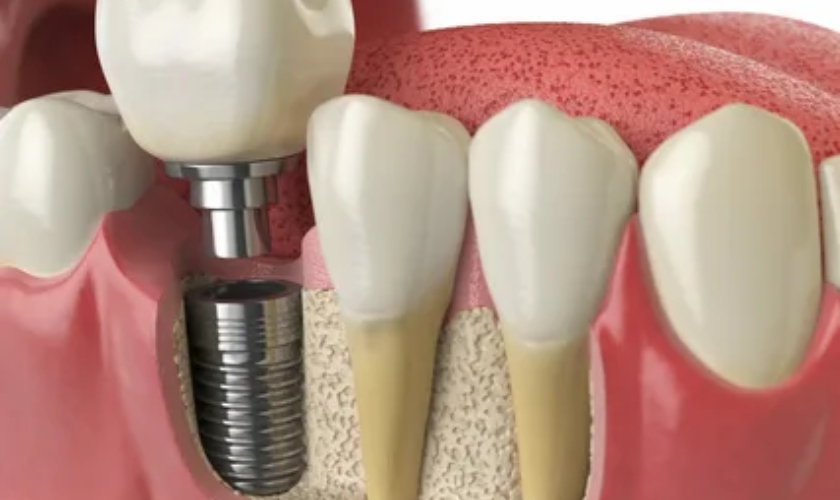 Maintaining Your Dental Implants Care Tips for Longevity