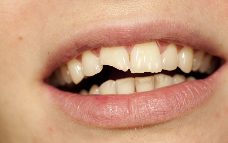 Cracked Tooth – Is It Considered A Dental Emergency?