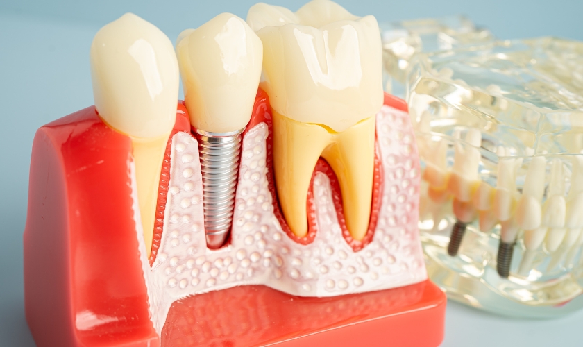 dental implants in Pasadena