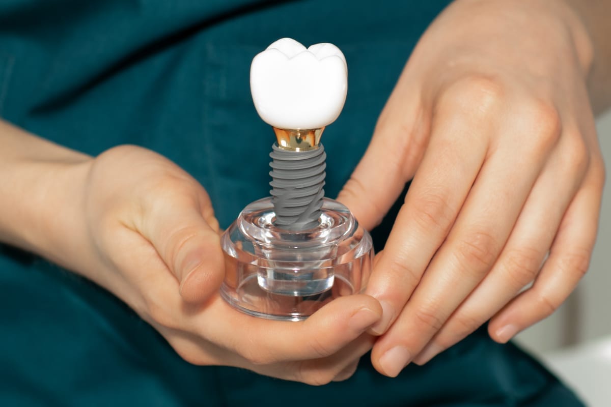 Dental Implants in Pasadena