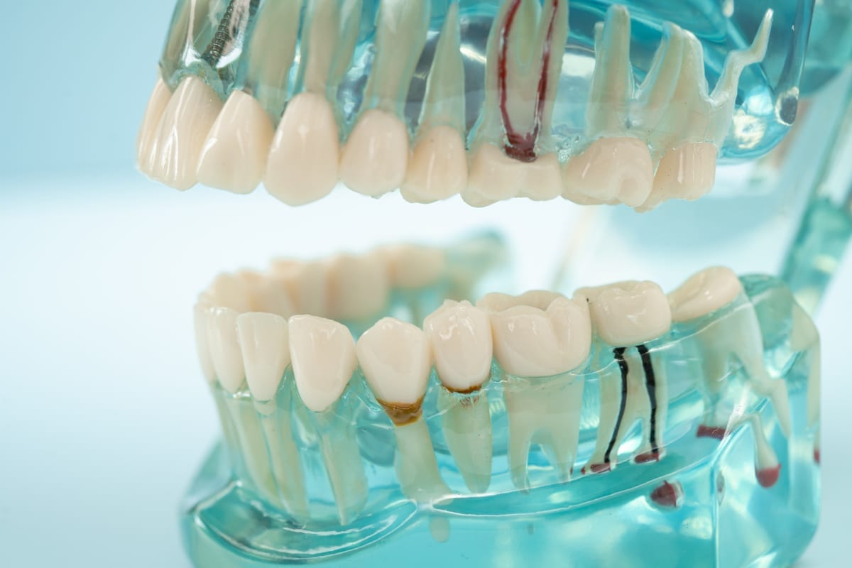 Root Canal Treatment in Pasadena
